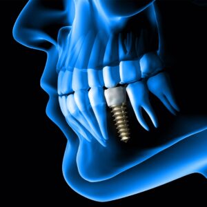 Top Rated Dental Implant Clinic in Dubai